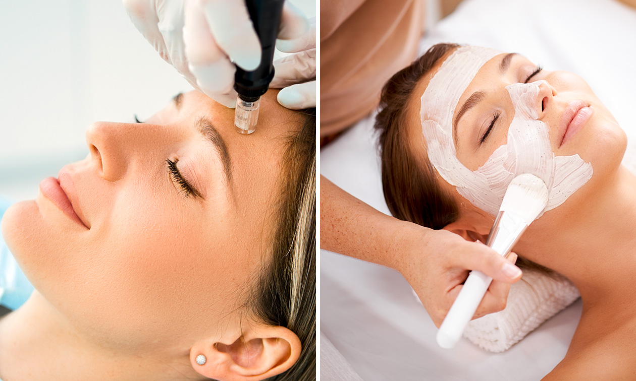Microneedling, chemical peeling of enzympeeling (30 of 60 min)